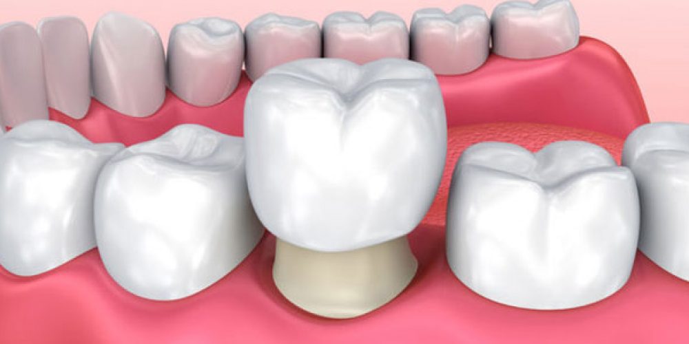 La couronne dentaire et les principaux types