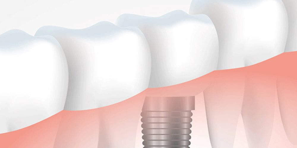 Urgences dentaires : tout savoir sur la greffe osseuse dentaire