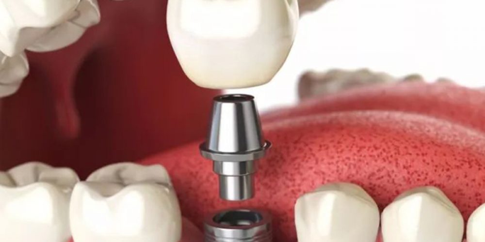 Pose d’implant dentaire : détails en ligne